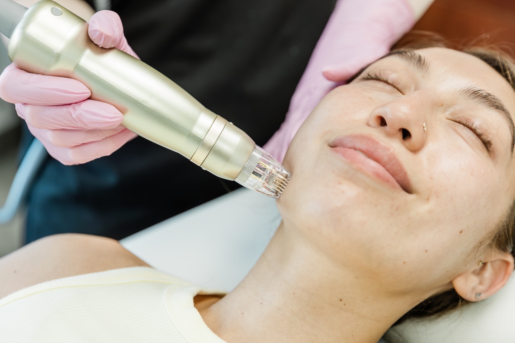 Sylfirm X RF microneedling session