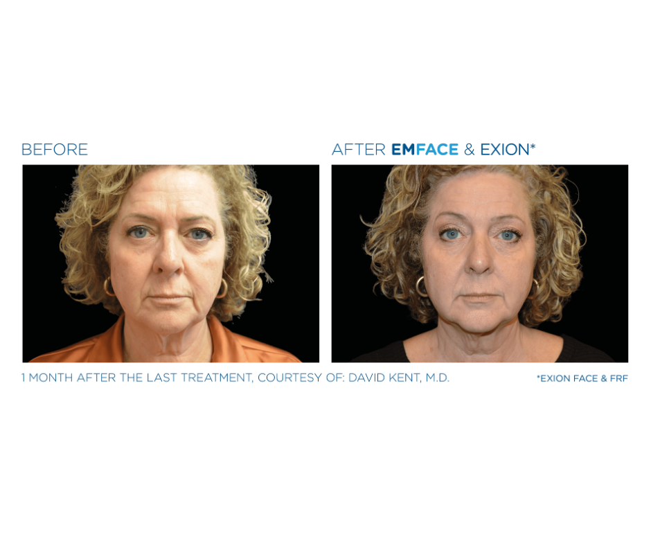 RF microneedling at Form & Function