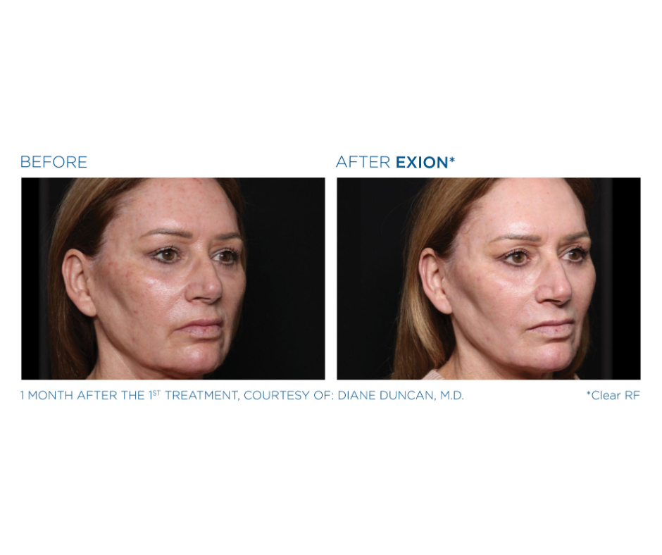 CO₂ laser resurfacing before and after